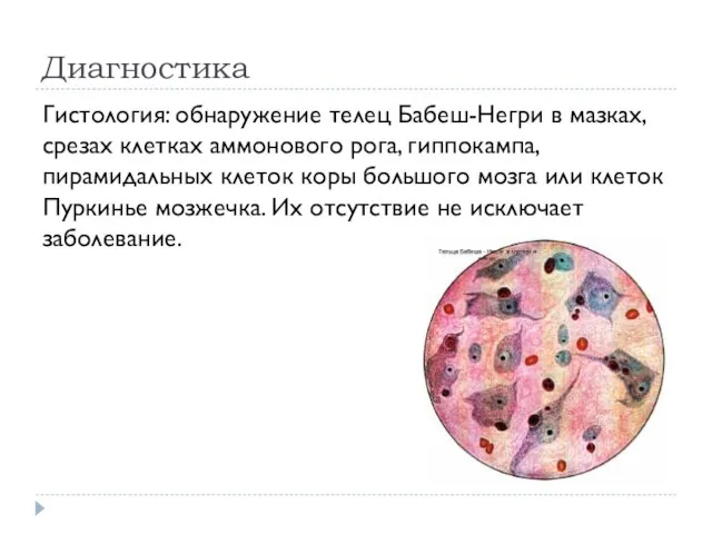 Диагностика Гистология: обнаружение телец Бабеш-Негри в мазках, срезах клетках аммонового рога,