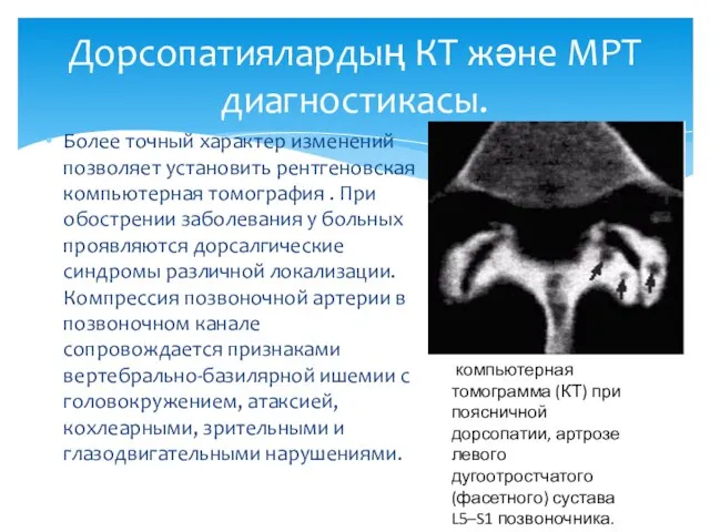 Более точный характер изменений позволяет установить рентгеновская компьютерная томография . При