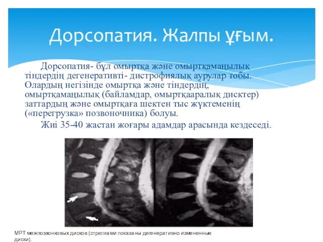 Дорсопатия- бұл омыртқа және омыртқамаңылық тіндердің дегенеративті- дистрофиялық аурулар тобы. Олардың