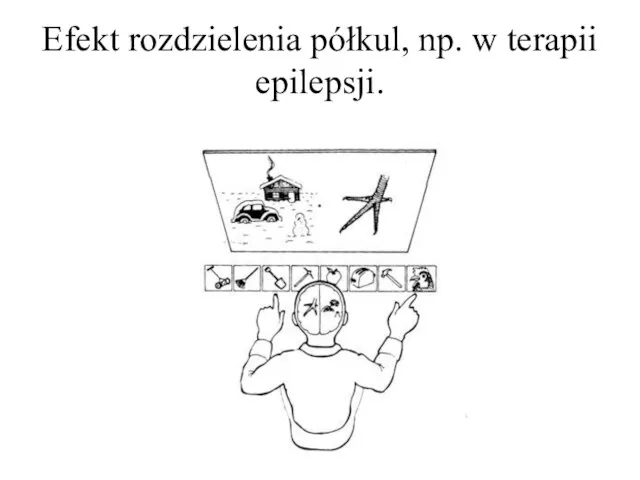 Efekt rozdzielenia półkul, np. w terapii epilepsji.