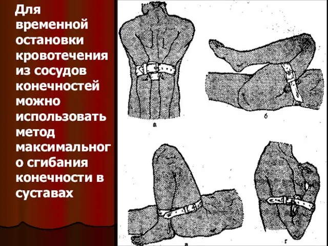 Для временной остановки кровотечения из сосудов конечностей можно использовать метод максимального сгибания конечности в суставах