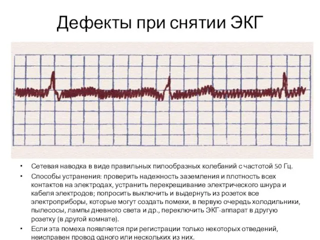 Дефекты при снятии ЭКГ Сетевая наводка в виде правильных пилообразных колебаний