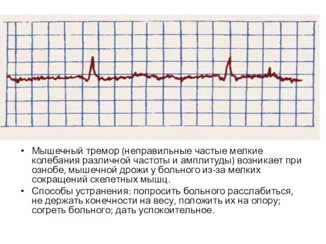 Мышечный тремор (неправильные частые мелкие колебания различной частоты и амплитуды) возникает