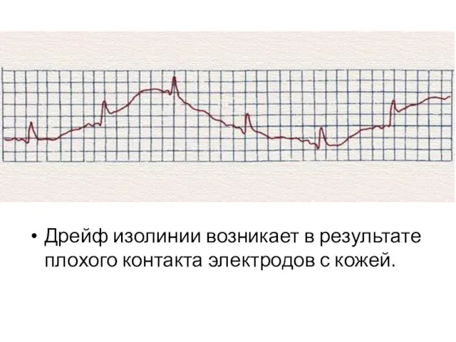 Дрейф изолинии возникает в результате плохого контакта электродов с кожей.