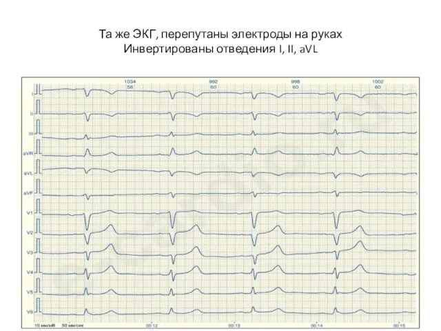 Та же ЭКГ, перепутаны электроды на руках Инвертированы отведения I, II, aVL