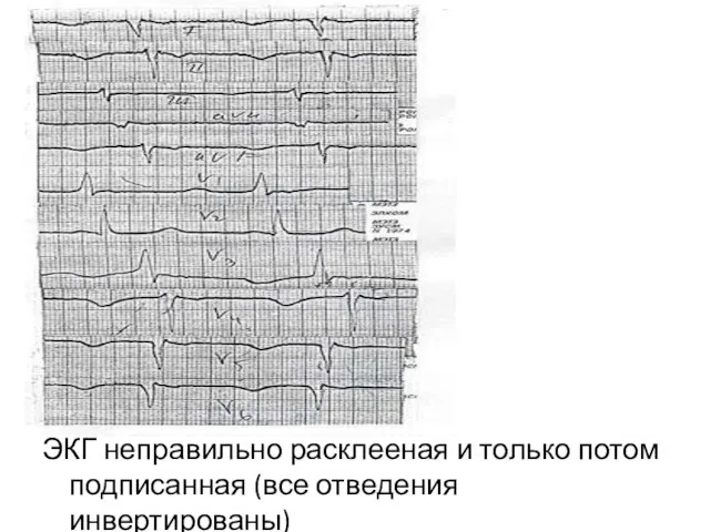 ЭКГ неправильно расклееная и только потом подписанная (все отведения инвертированы)