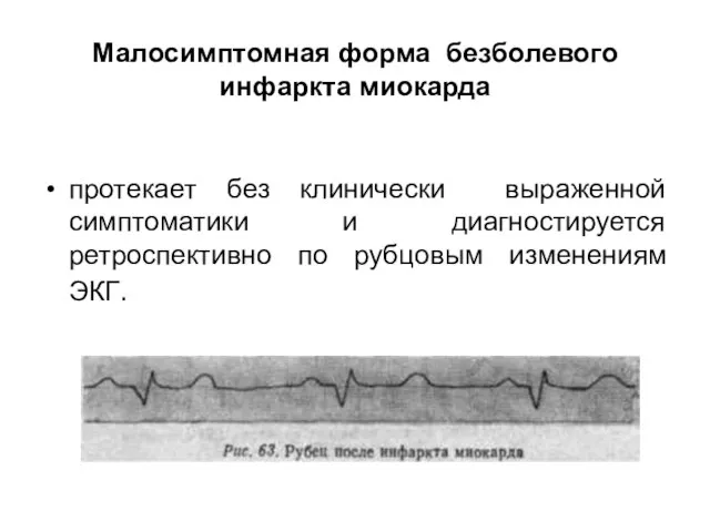 Малосимптомная форма безболевого инфаркта миокарда протекает без клинически выраженной симптоматики и