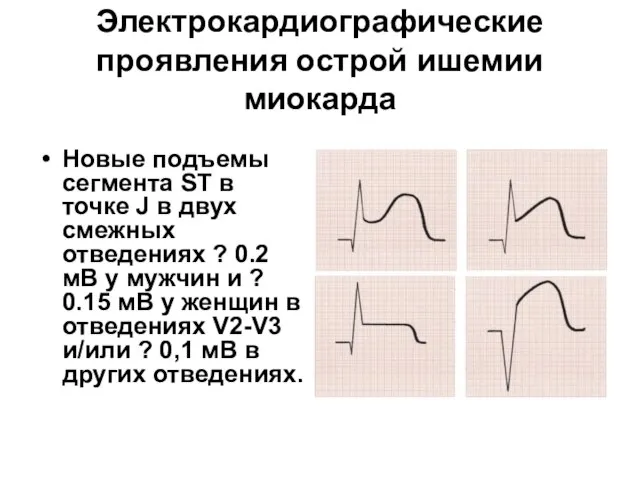 Электрокардиографические проявления острой ишемии миокарда Новые подъемы сегмента ST в точке