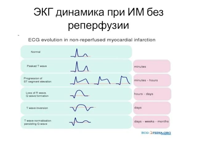 ЭКГ динамика при ИМ без реперфузии