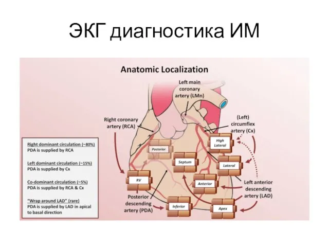 ЭКГ диагностика ИМ