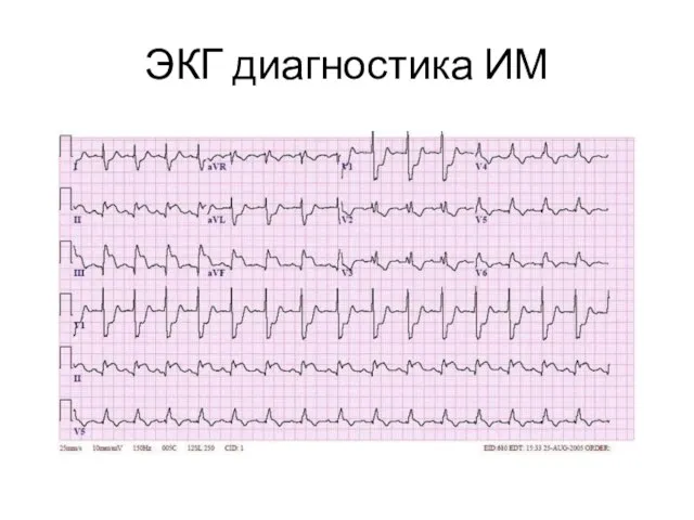 ЭКГ диагностика ИМ