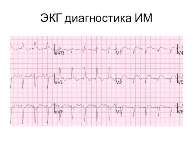 ЭКГ диагностика ИМ