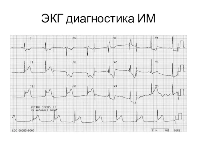 ЭКГ диагностика ИМ