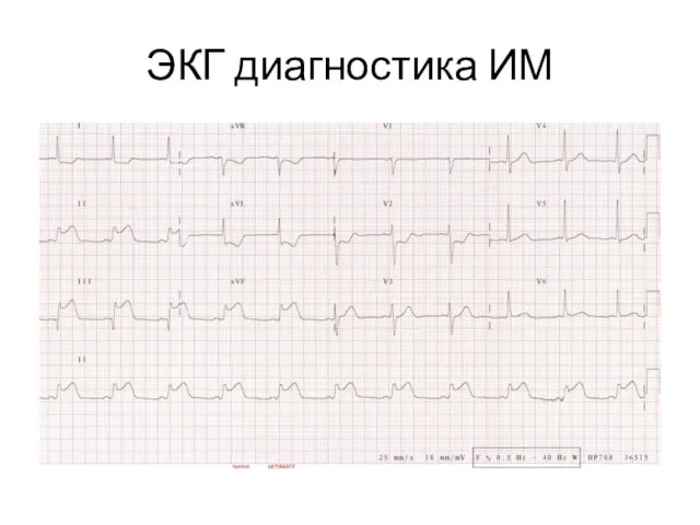 ЭКГ диагностика ИМ