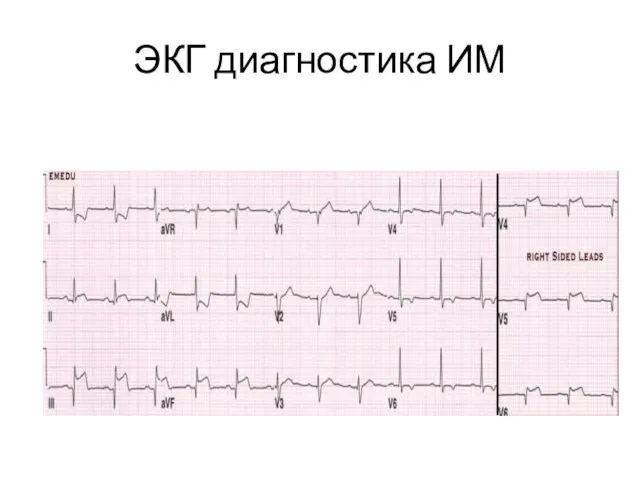 ЭКГ диагностика ИМ