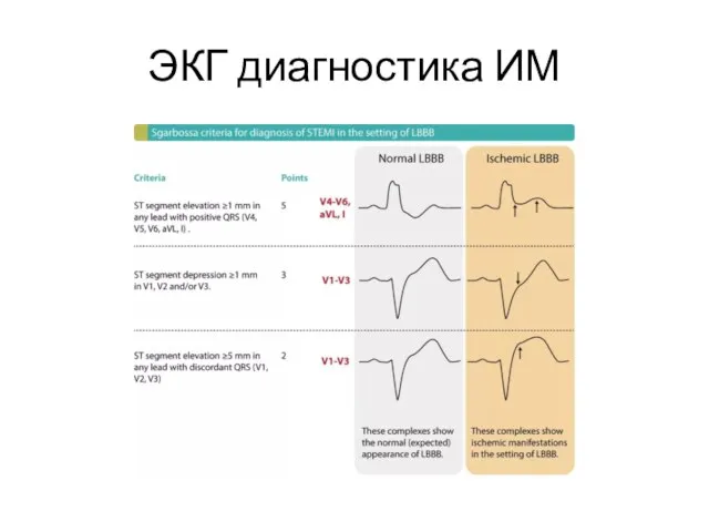 ЭКГ диагностика ИМ