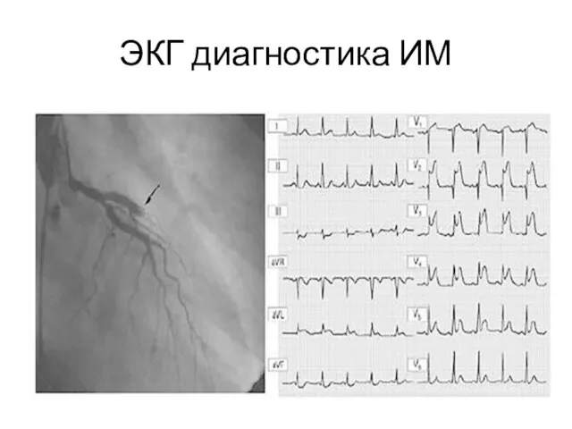 ЭКГ диагностика ИМ