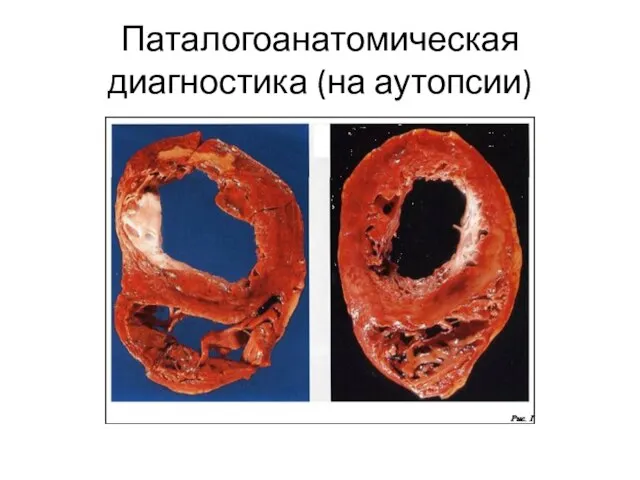 Паталогоанатомическая диагностика (на аутопсии)