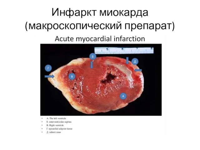 Инфаркт миокарда (макроскопический препарат)