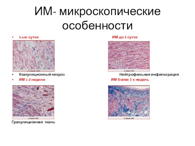 ИМ- микроскопические особенности 1-ые сутки ИМ до 3 суток Коагуляционный некроз