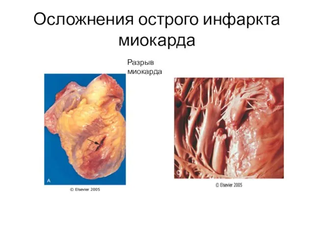 Осложнения острого инфаркта миокарда Разрыв миокарда