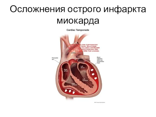 Осложнения острого инфаркта миокарда