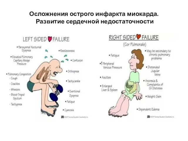 Осложнения острого инфаркта миокарда. Развитие сердечной недостаточности