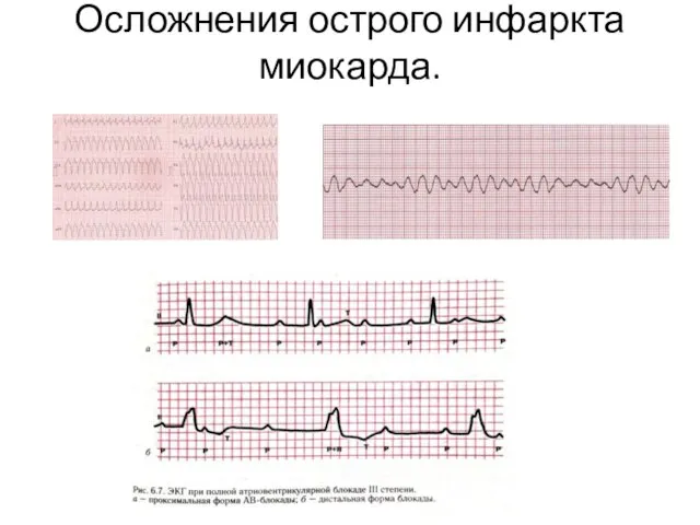 Осложнения острого инфаркта миокарда.