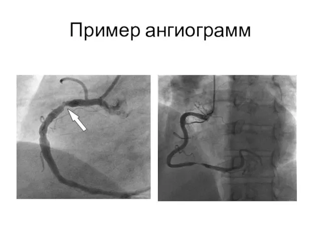 Пример ангиограмм