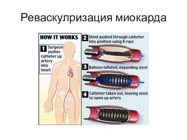 Реваскулризация миокарда