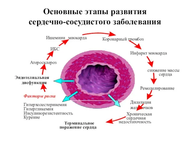 Основные этапы развития сердечно-сосудистого заболевания