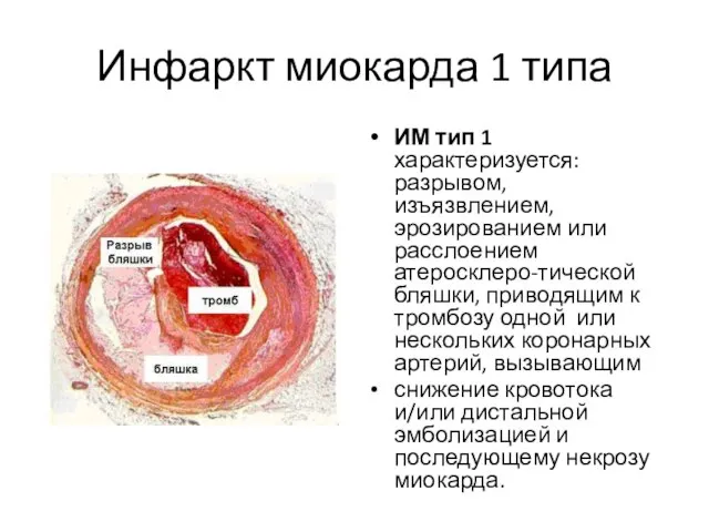 Инфаркт миокарда 1 типа ИМ тип 1 характеризуется: разрывом, изъязвлением, эрозированием