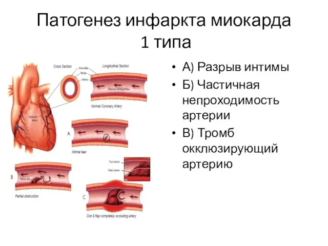 Патогенез инфаркта миокарда 1 типа А) Разрыв интимы Б) Частичная непроходимость артерии В) Тромб окклюзирующий артерию