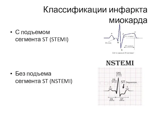 Классификации инфаркта миокарда С подъемом сегмента ST (STEMI) Без подъема сегмента ST (NSTEMI)
