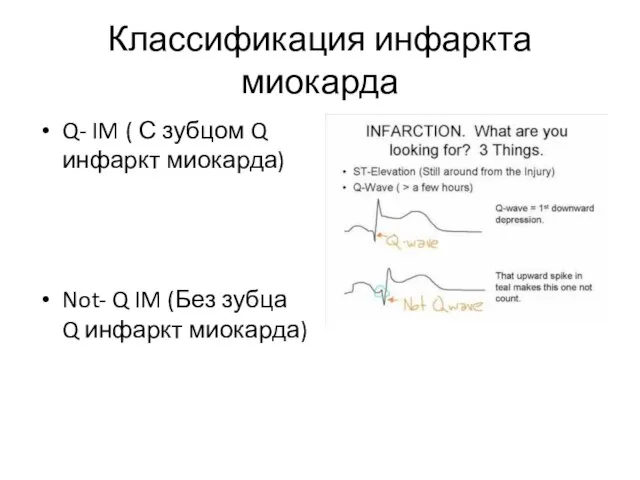 Классификация инфаркта миокарда Q- IM ( С зубцом Q инфаркт миокарда)