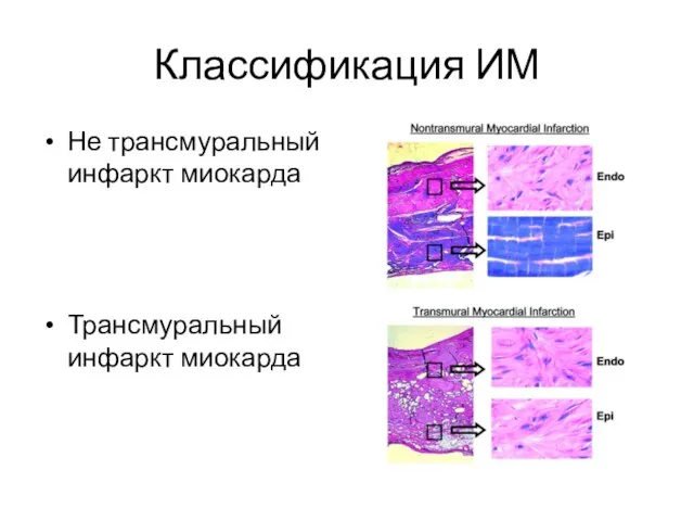 Классификация ИМ Не трансмуральный инфаркт миокарда Трансмуральный инфаркт миокарда