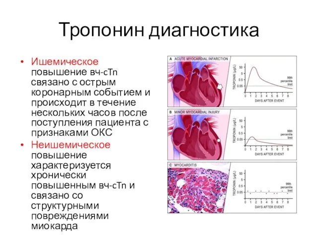 Тропонин диагностика Ишемическое повышение вч-cTn связано с острым коронарным событием и