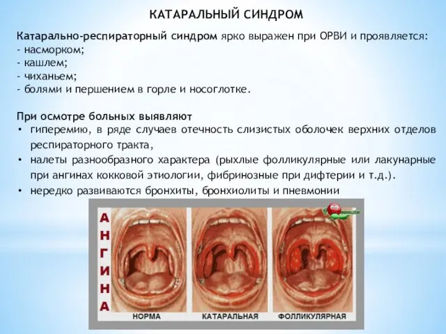 КАТАРАЛЬНЫЙ СИНДРОМ Катарально-респираторный синдром ярко выражен при ОРВИ и проявляется: -