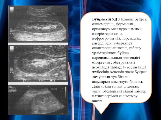 Бүйректің УДЗ арқылы бүйрек өлшемдерін , формасын , орналасуы мен құрылымдық