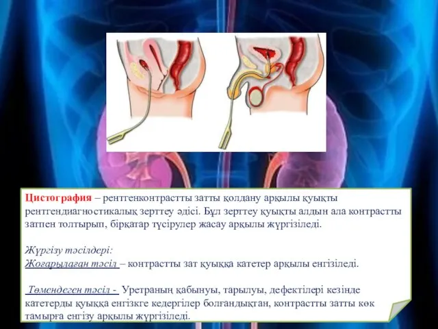 Цистография – рентгенконтрастты затты қолдану арқылы қуықты рентгендиагностикалық зерттеу әдісі. Бұл