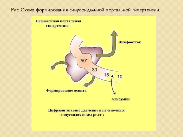 Рис. Схема формирования синусоидальной портальной гипертензии.