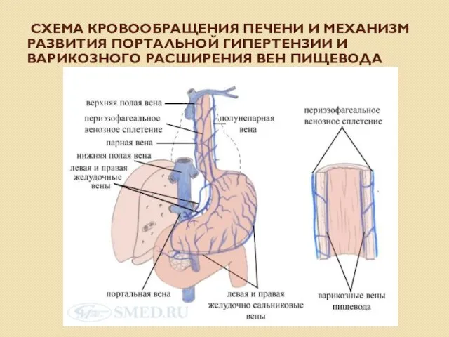 СХЕМА КРОВООБРАЩЕНИЯ ПЕЧЕНИ И МЕХАНИЗМ РАЗВИТИЯ ПОРТАЛЬНОЙ ГИПЕРТЕНЗИИ И ВАРИКОЗНОГО РАСШИРЕНИЯ ВЕН ПИЩЕВОДА