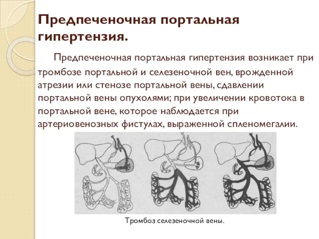 Предпеченочная портальная гипертензия. Предпеченочная портальная гипертензия возникает при тромбозе портальной и