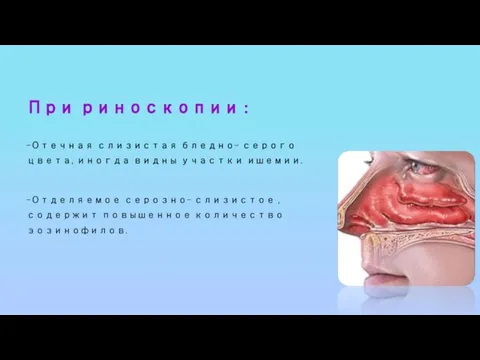 При риноскопии : –Отечная слизистая бледно- серого цвета, иногда видны участки