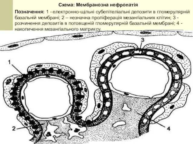 Схема: Мембранозна нефропатія Позначення: 1 - електронно-щільні субепітеліальні депозити в гломерулярній