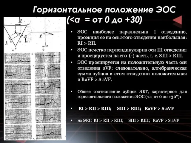 Горизонтальное положение ЭОС ( ЭОС наиболее параллельна I отведению, проекция ее