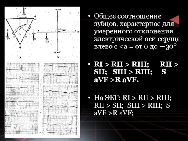 Общее соотношение зубцов, характерное для умеренного отклонения электрической оси сердца влево