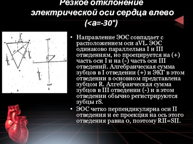 Резкое отклонение электрической оси серд­ца влево ( Направление ЭОС совпадает с