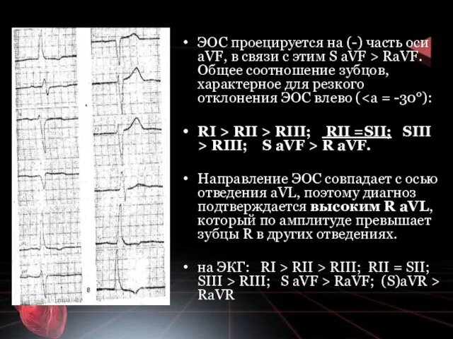 ЭОС проецируется на (-) часть оси аVF, в связи с этим