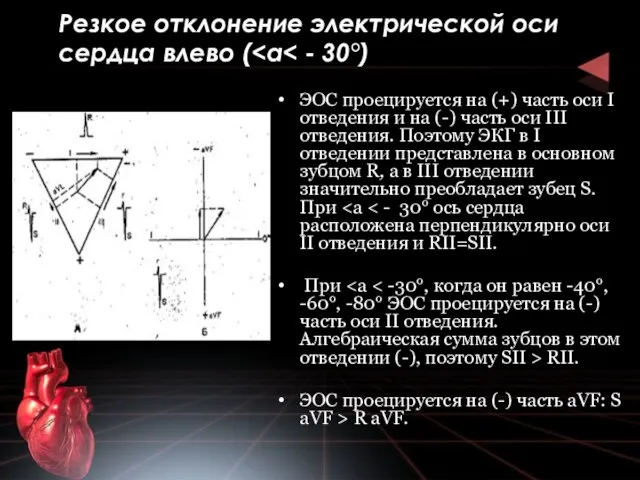 Резкое отклонение электрической оси серд­ца влево ( ЭОС проецируется на (+)